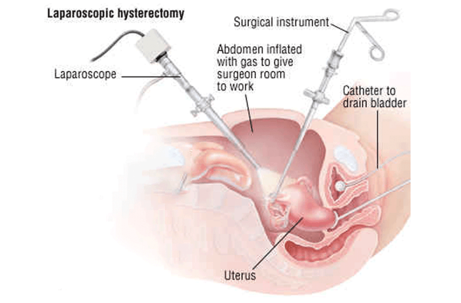 Hysterectomy (TLH)